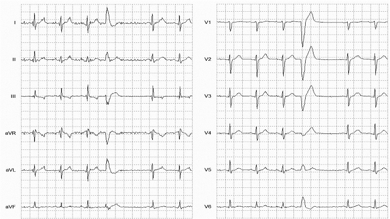 VEB Left Bundle Branch Morphology 12 Lead EKG